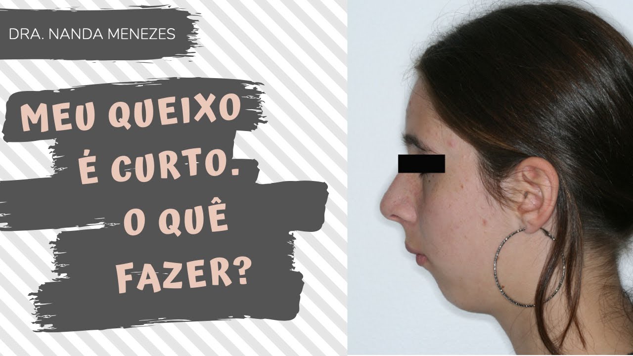 Seu queixo é curto? Pode ser Classe 2 | Dra Nanda Menezes