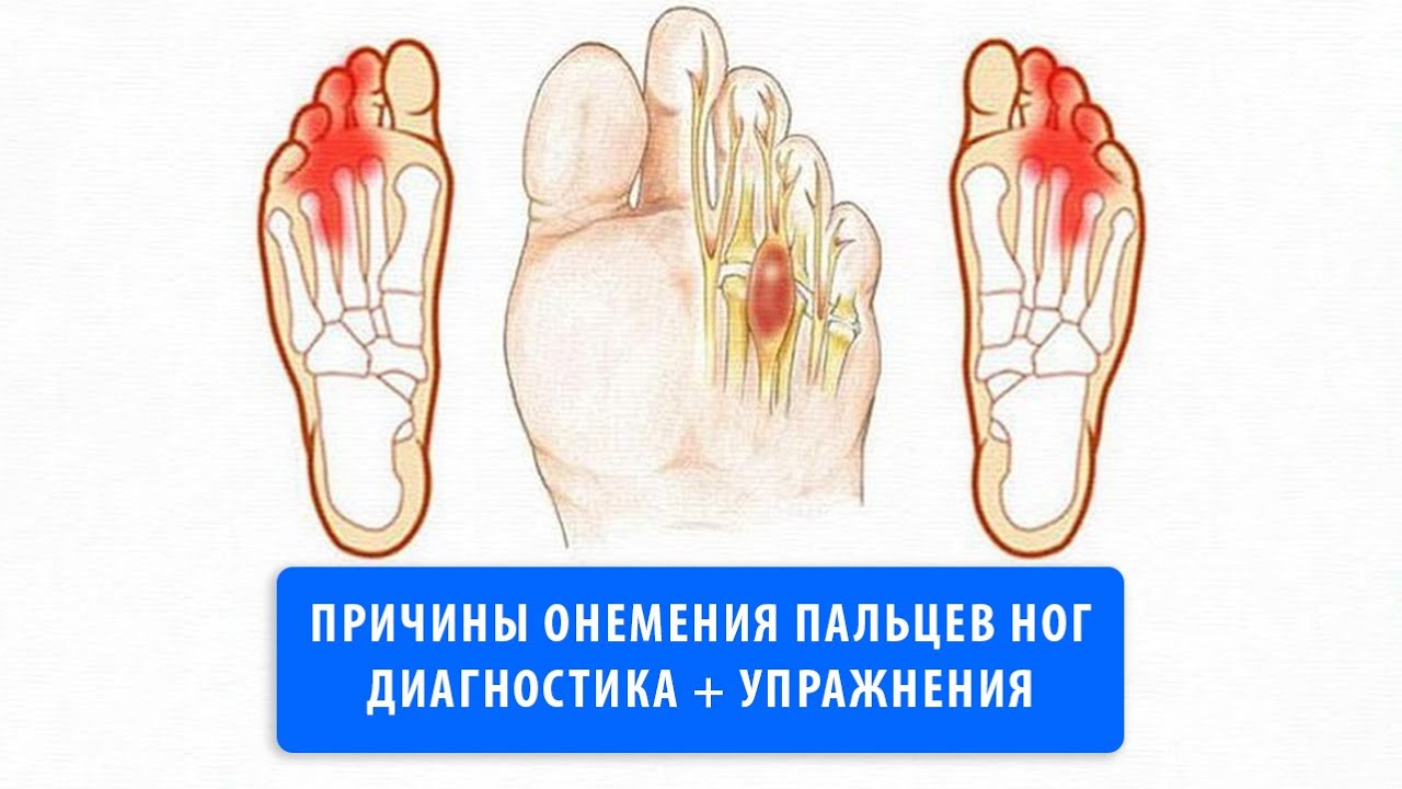 Немеют пальцы ног? Неврома Мортона — как избежать операции