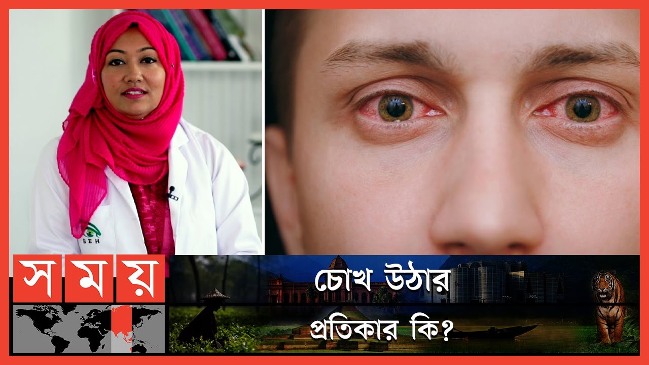 চোখ উঠা কি? কেন হয়? | Pink Eye | Conjunctivitis | Dr. Sabrina Rahmatullah | Somoy TV