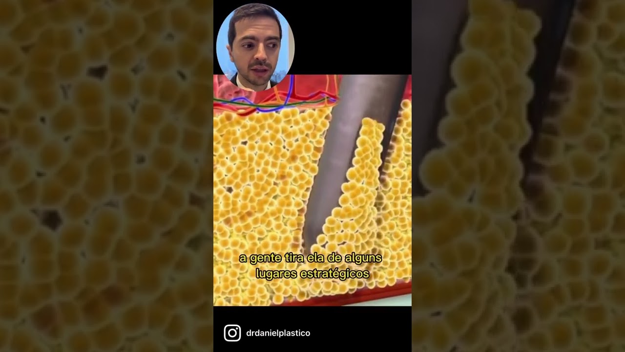 Como &eacute; feita a Lipo Hd