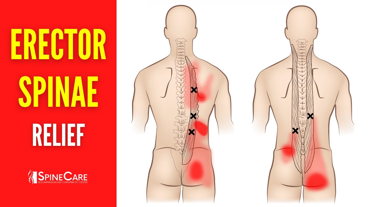 How to Fix Erector Spinae Pain FOR GOOD