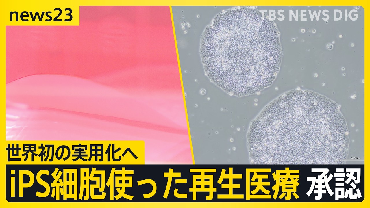 世界初の実用化へ&nbsp;iPS細胞を使った2つの再生医療製品&nbsp;条件期限付きで承認　早ければ今夏にも【news23】｜TBS&nbsp;NEWS&nbsp;DIG
