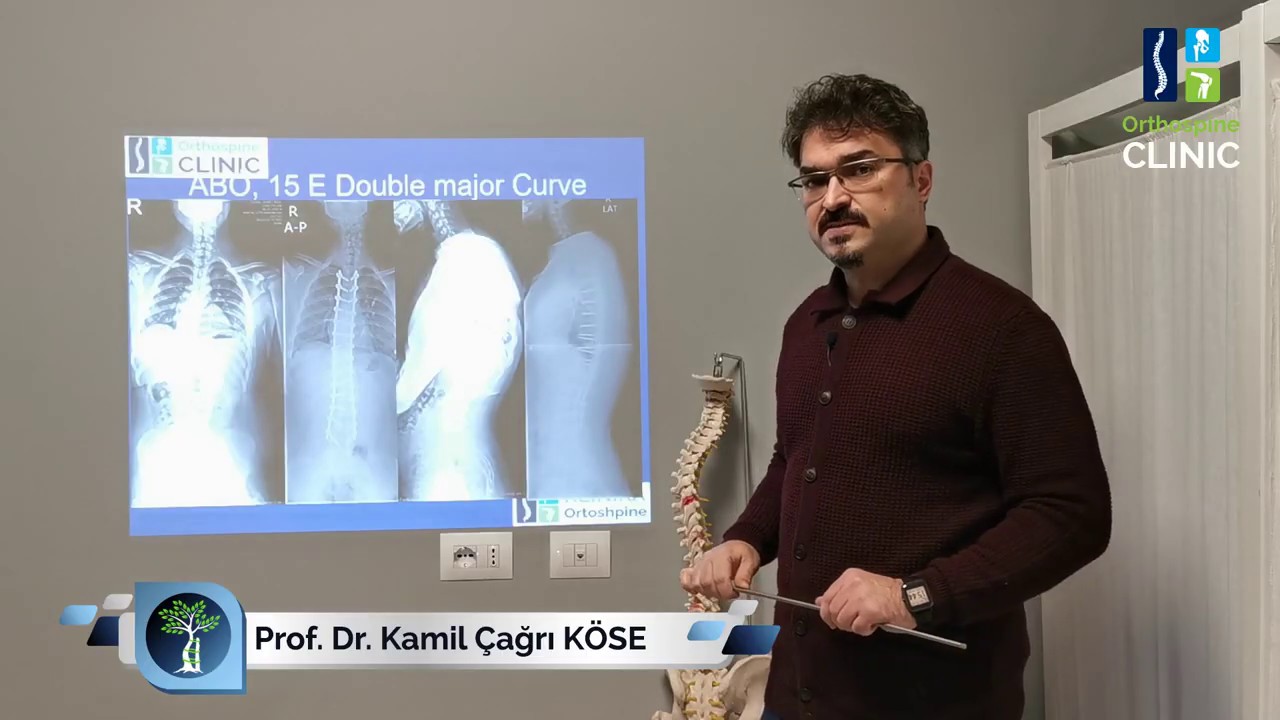 1 ay önce 60 derece skolyozdan ameliyat oldum iyileşince ne kadar eğilebilirim?