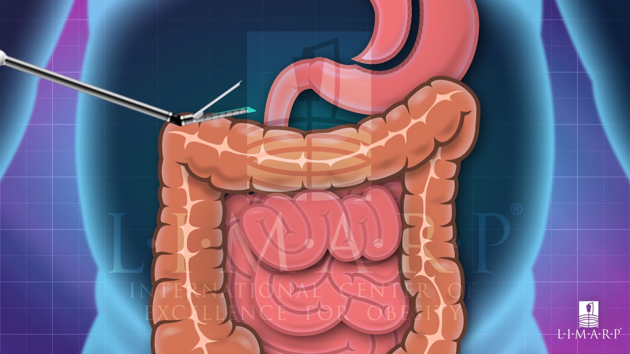Mini Gastric Bypass Sugery Tijuana México - LIMARP / DR. POMPA