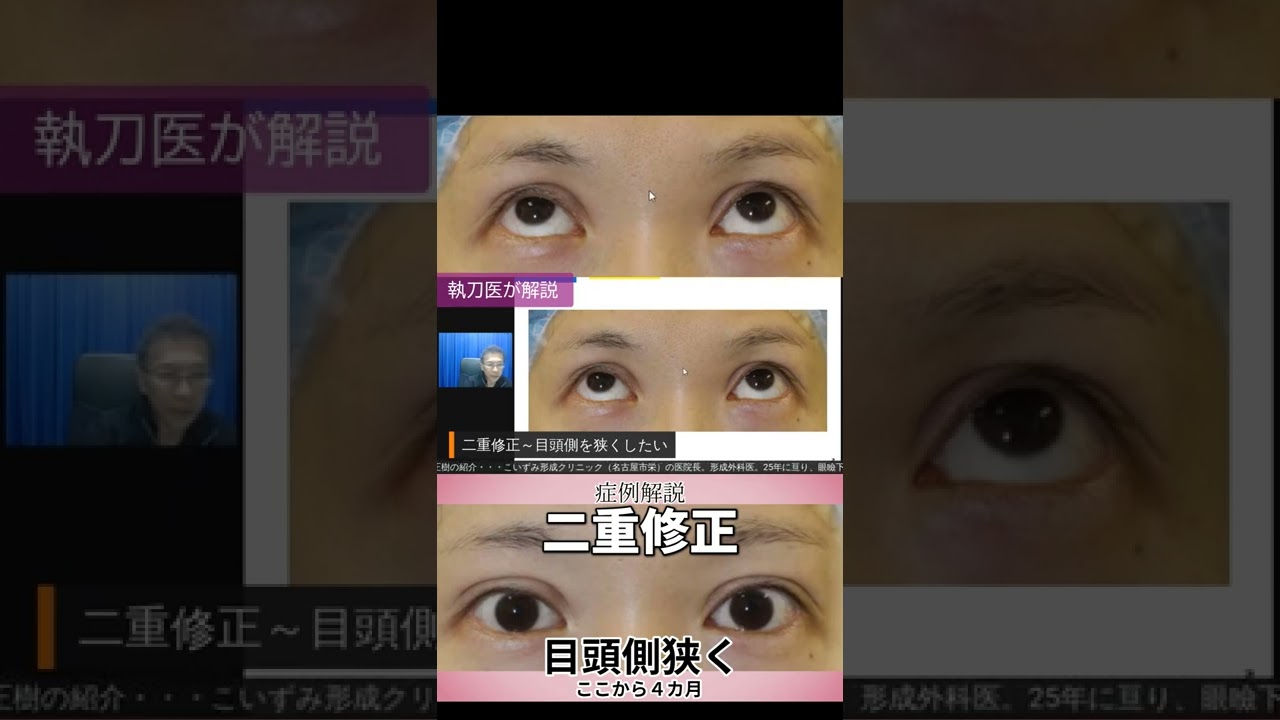 二重瞼の修正。目頭側を狭く