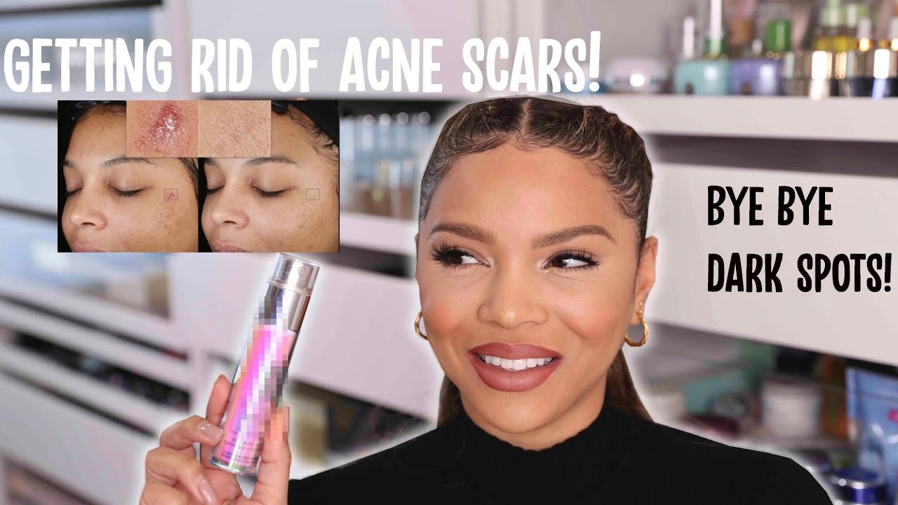 How I got rid of my Acne Scars | Deniseasiam