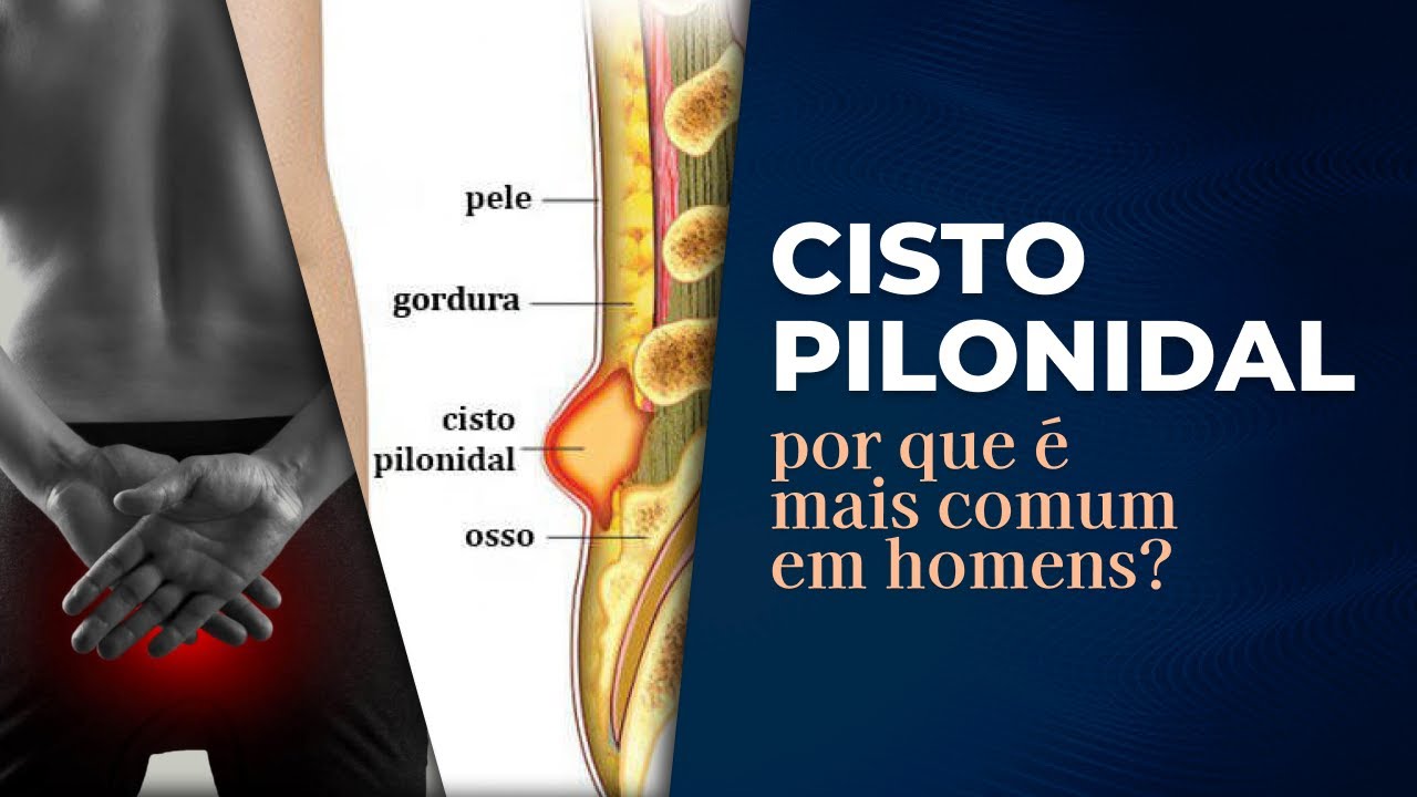 Por que o Cisto Pilonidal é mais comum em homens