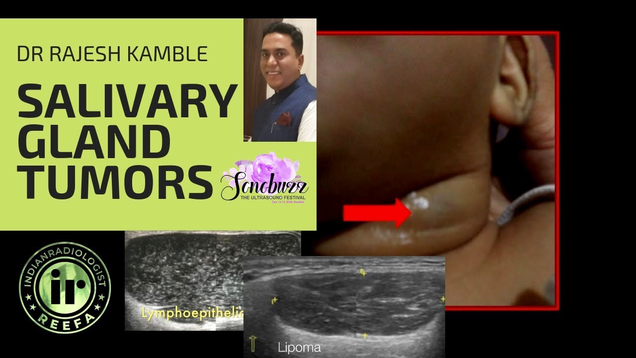 TMT: Salivary Gland Tumors (2)- Dr Rajesh Kamble