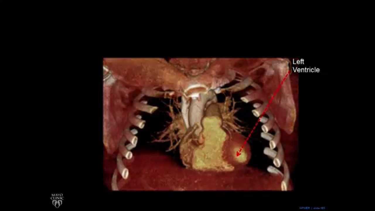 Plain Film Cardiac and Vascular Anatomy - Frontal Radiograph - Philip Araoz, M.D. - Part 10 of 10