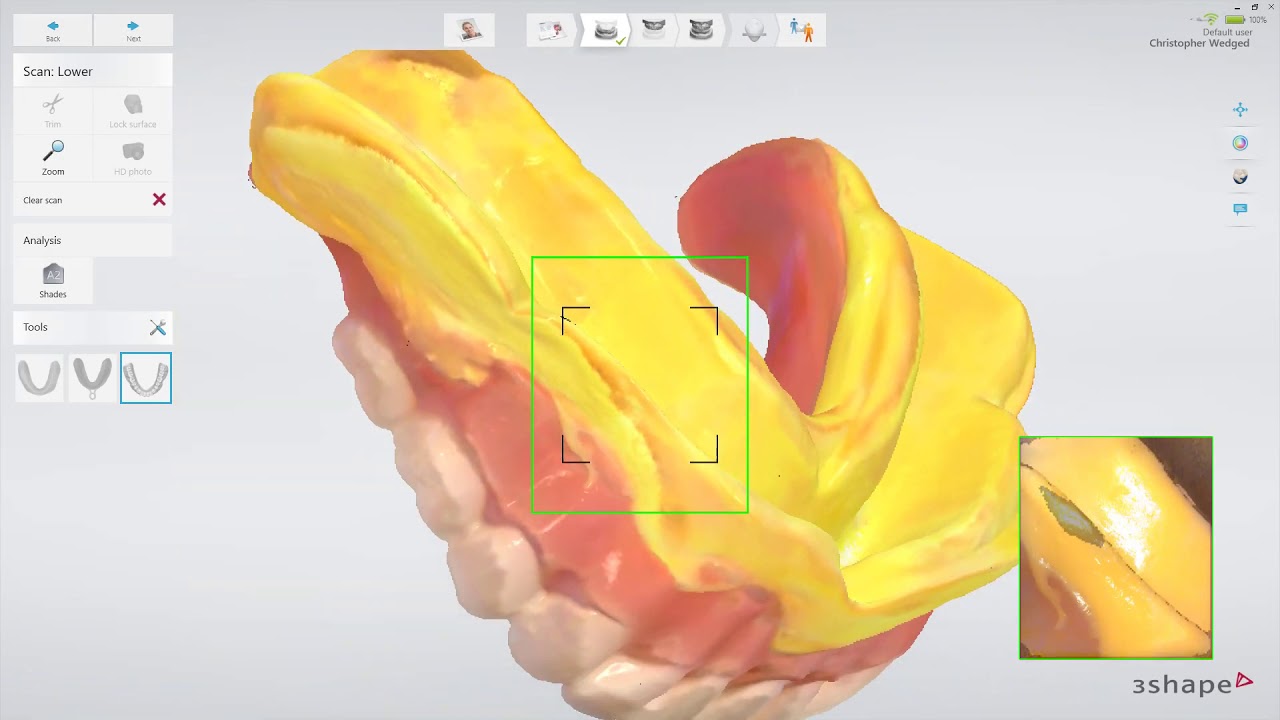 3Shape TRIOS Edentulous patient - Scannen bestaande prothese voor exacte kopie of afrdukprothese