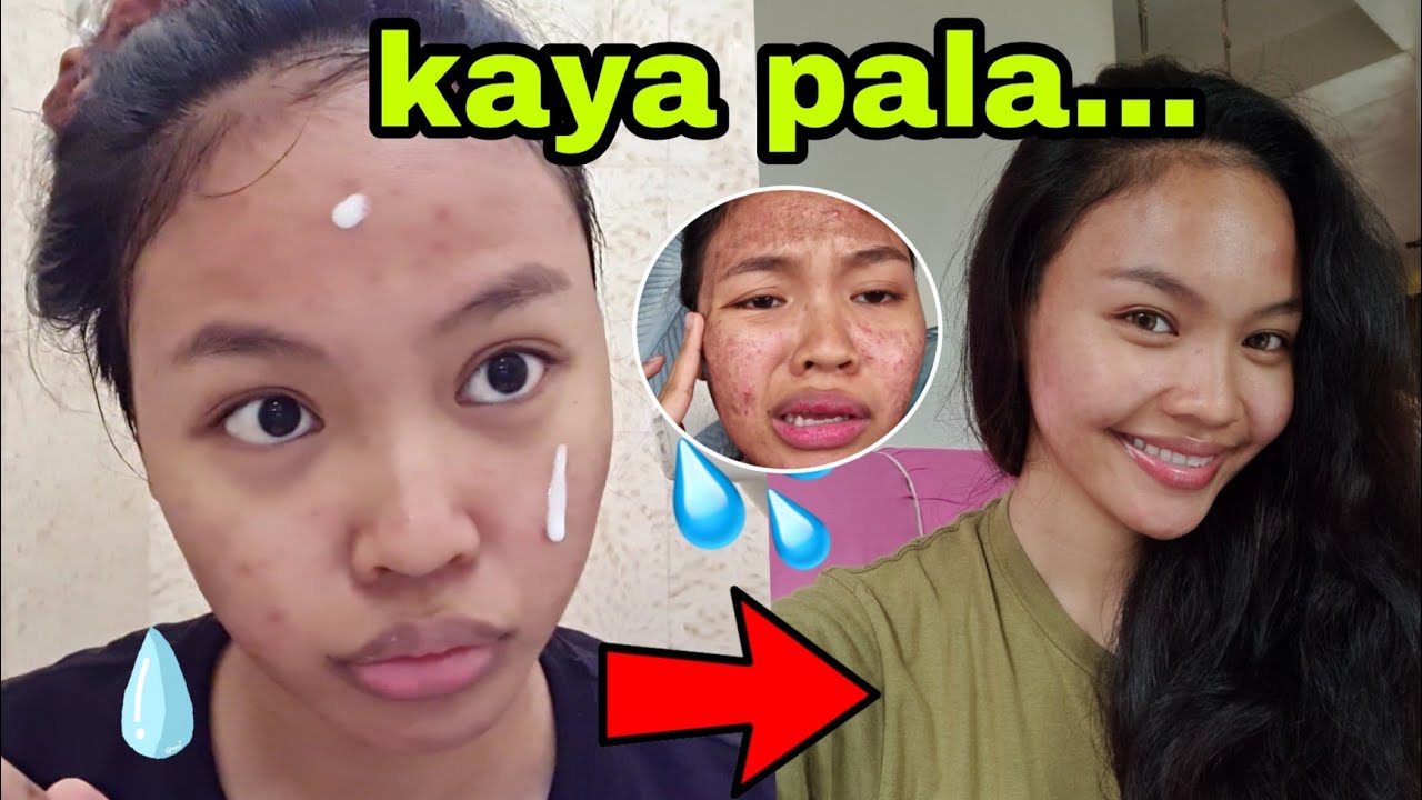 My&nbsp;skincare after my L&Aacute;ser TREATM&Eacute;NT