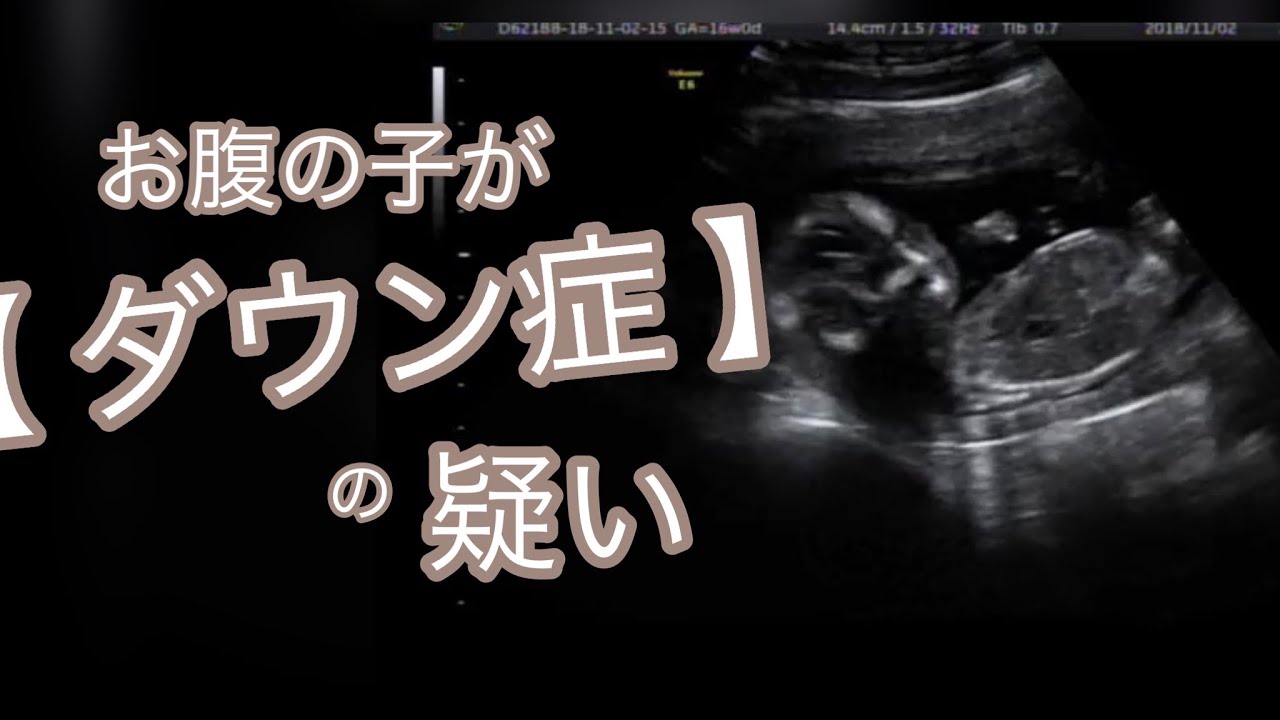 【ダウン症/告知】お腹の中の子がダウン症の疑い【妊娠  エコー】