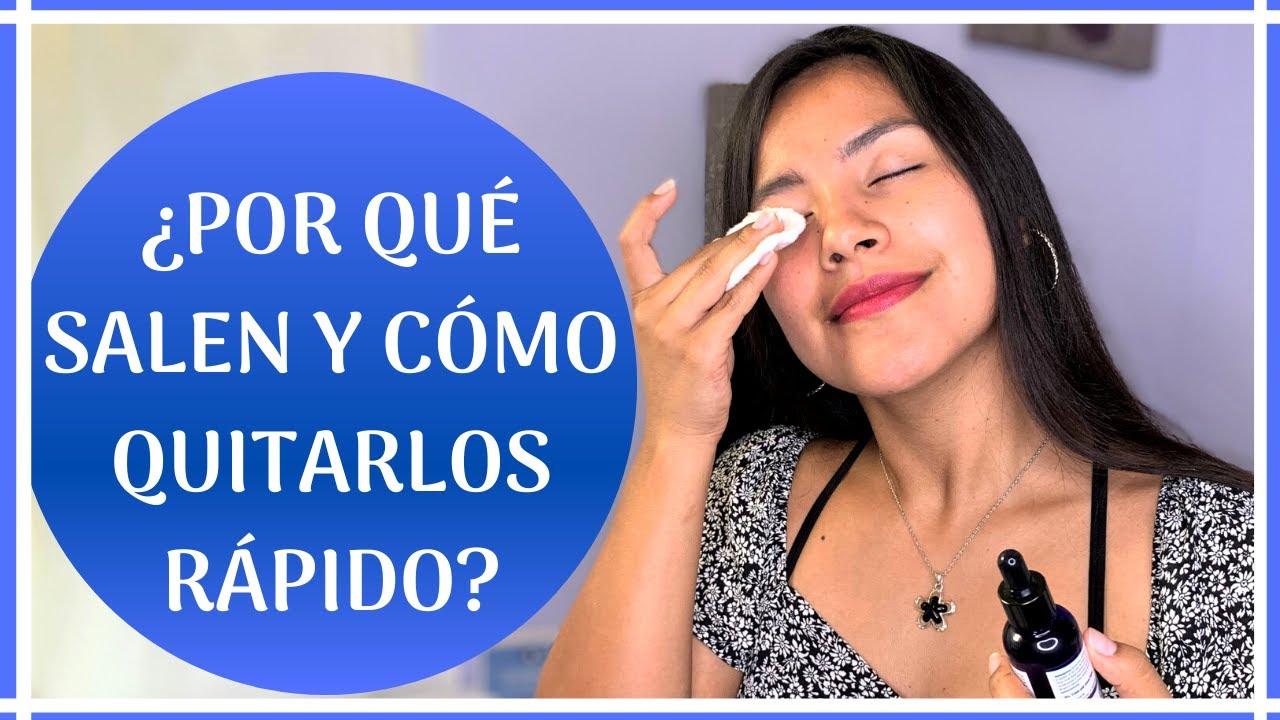 POR QUÉ SALE UN ORZUELO Y CÓMO QUITARLO RÁPIDO