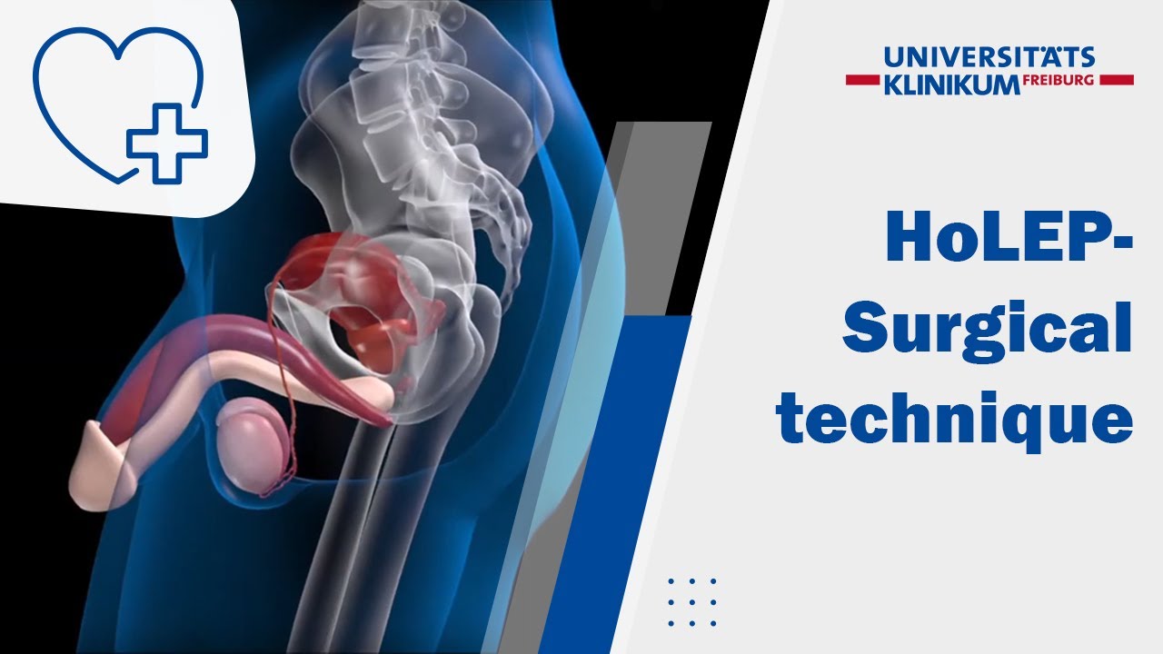 ANIMATION - Holmium Laser Enucleation of the Prostate (HoLEP) – „3 horseshoe technique“