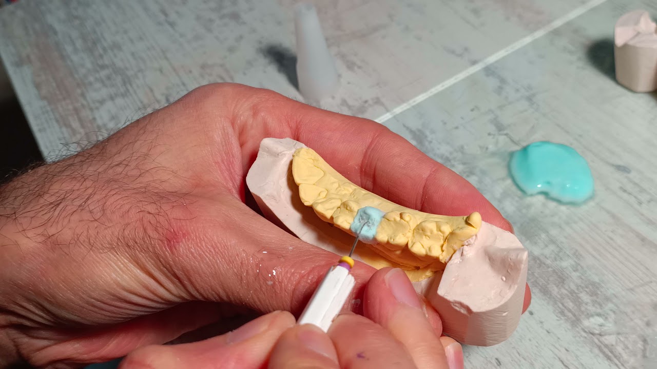 porselen tepimi (üst 2.premolar) A2