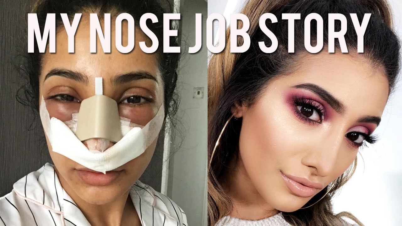MY NOSE JOB SURGERY STORY AND VLOG - Cost and Experience