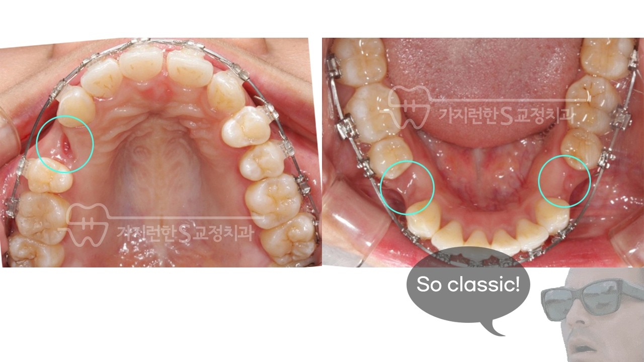 앞니 하나가 없는 결손치 돌출입 ㅣ 김포 교정