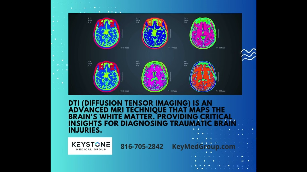 DTI: Advanced Brain Imaging for TBIs