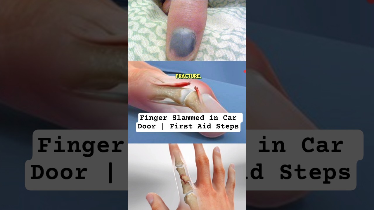 Car Door Injury | What To Do in First 5 Min