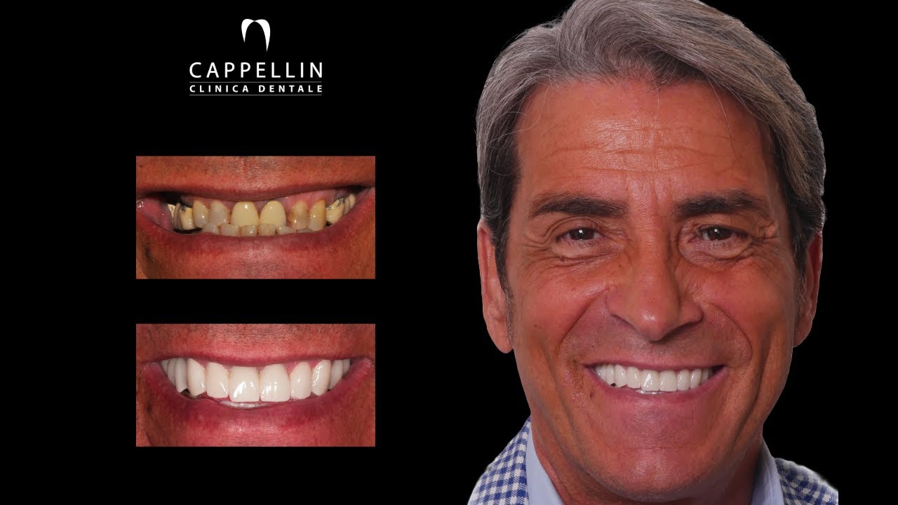 IMPIANTI DENTALI CON CARICO IMMEDIATO
