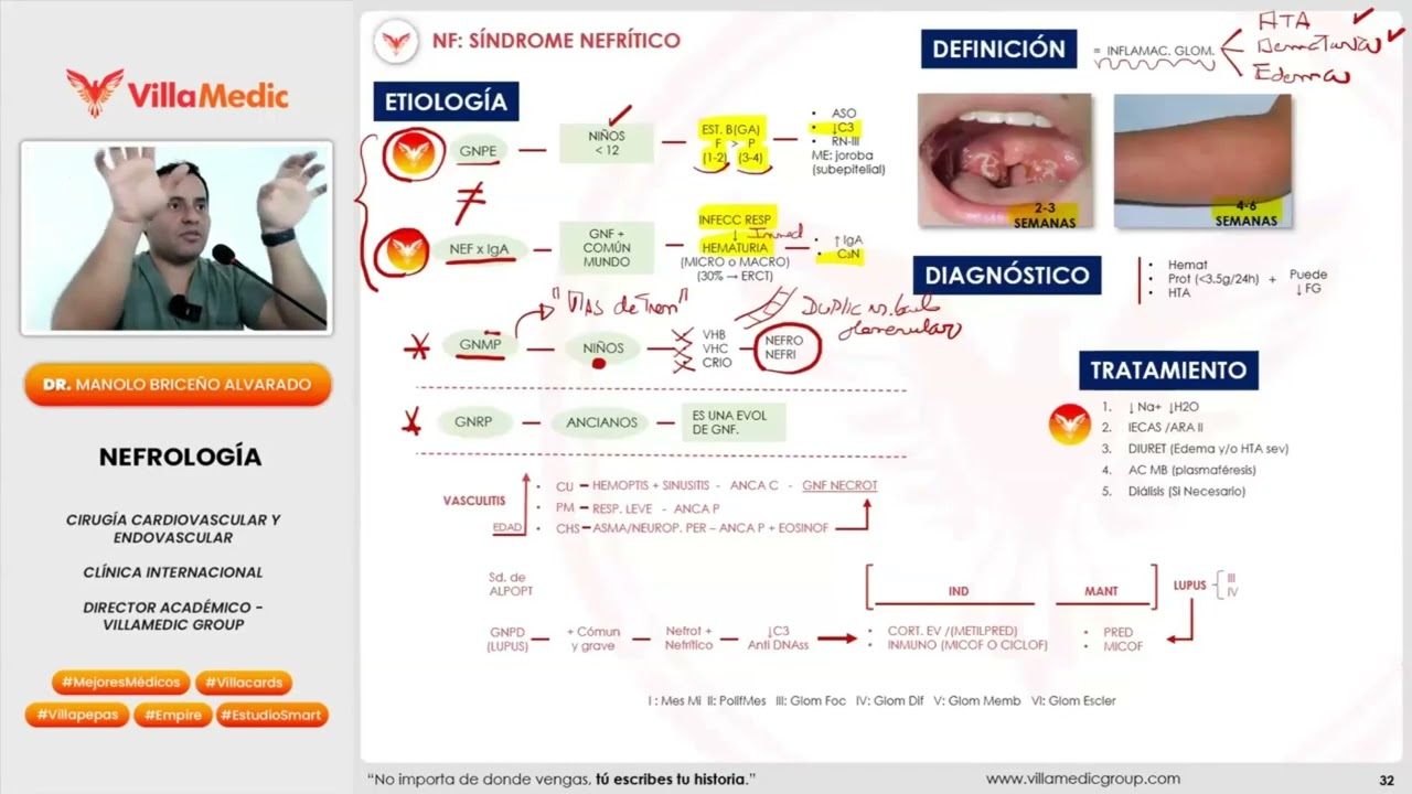SÍNDROME NEFRÍTICO: HEMATURIA, EDEMA E HIPERTENSIÓN POR DAÑO GLOMERULAR 2026 VILLAMEDIC