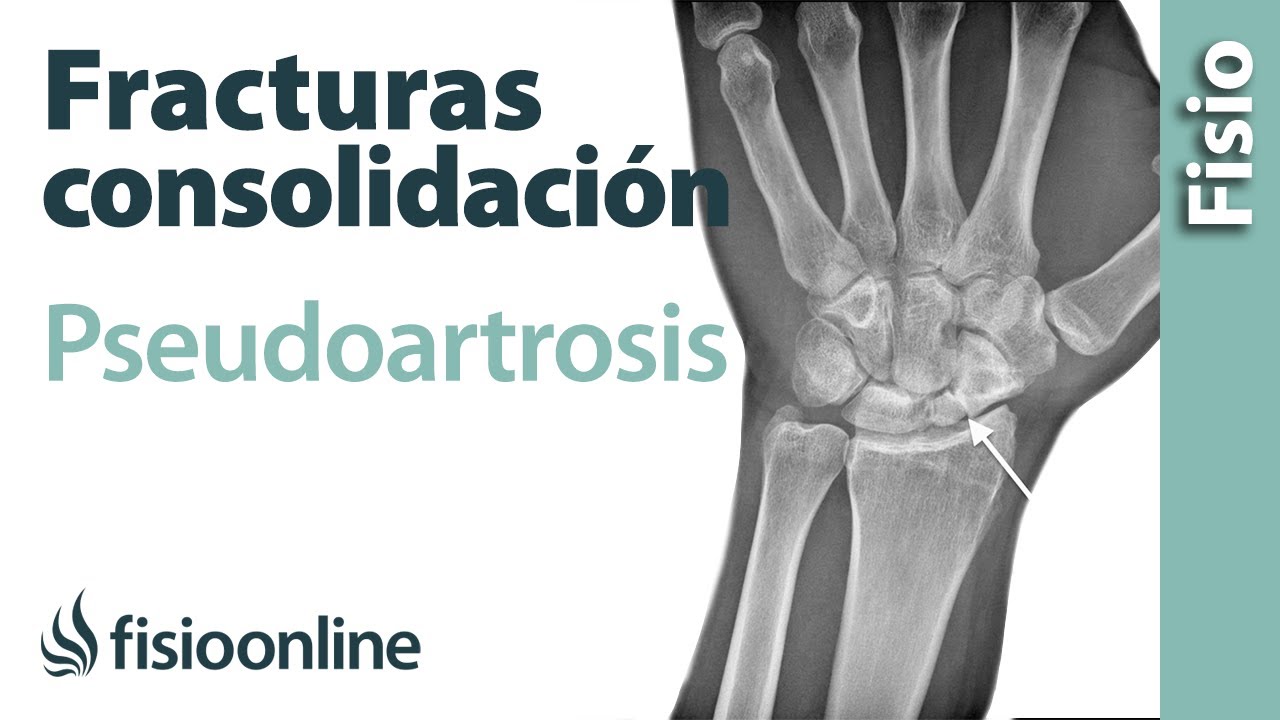 Pseudoartrosis - Mala consolidación de fracturas - ¿Qué es?