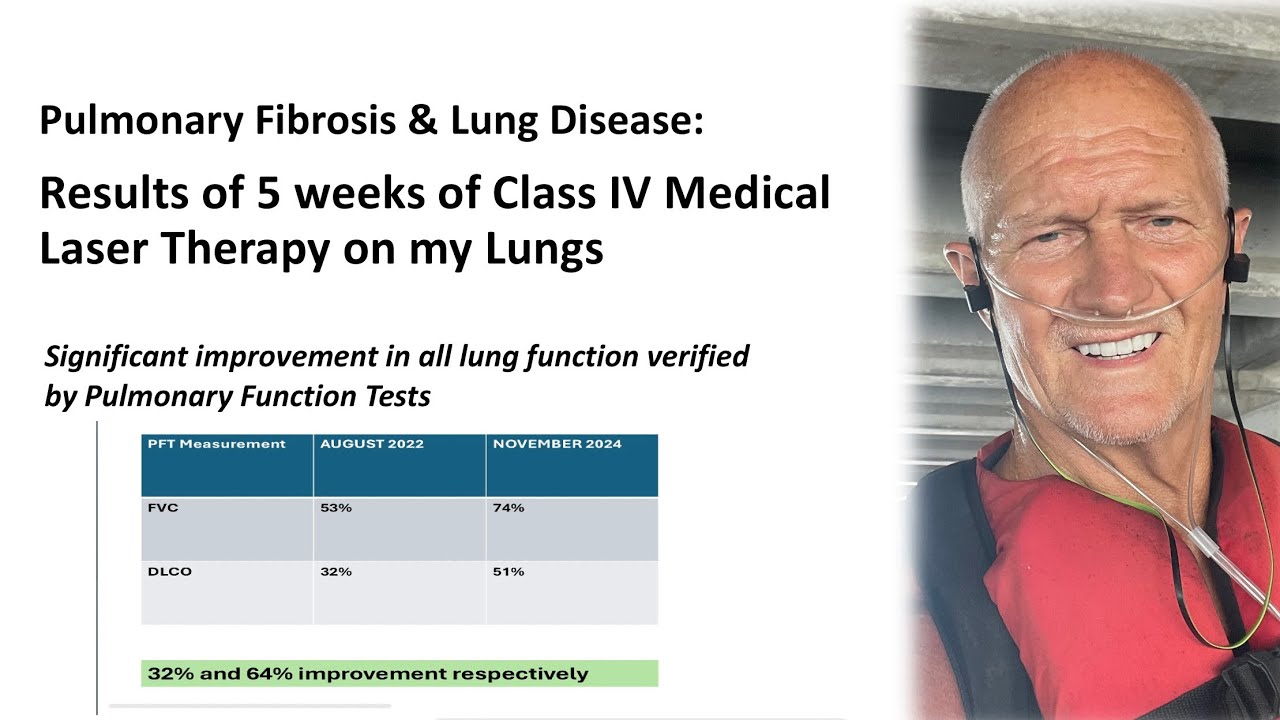 Update on my results of Laser Therapy for lungs: