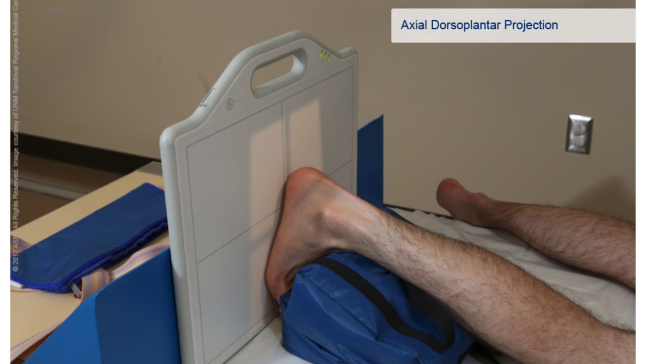 Calcaneus