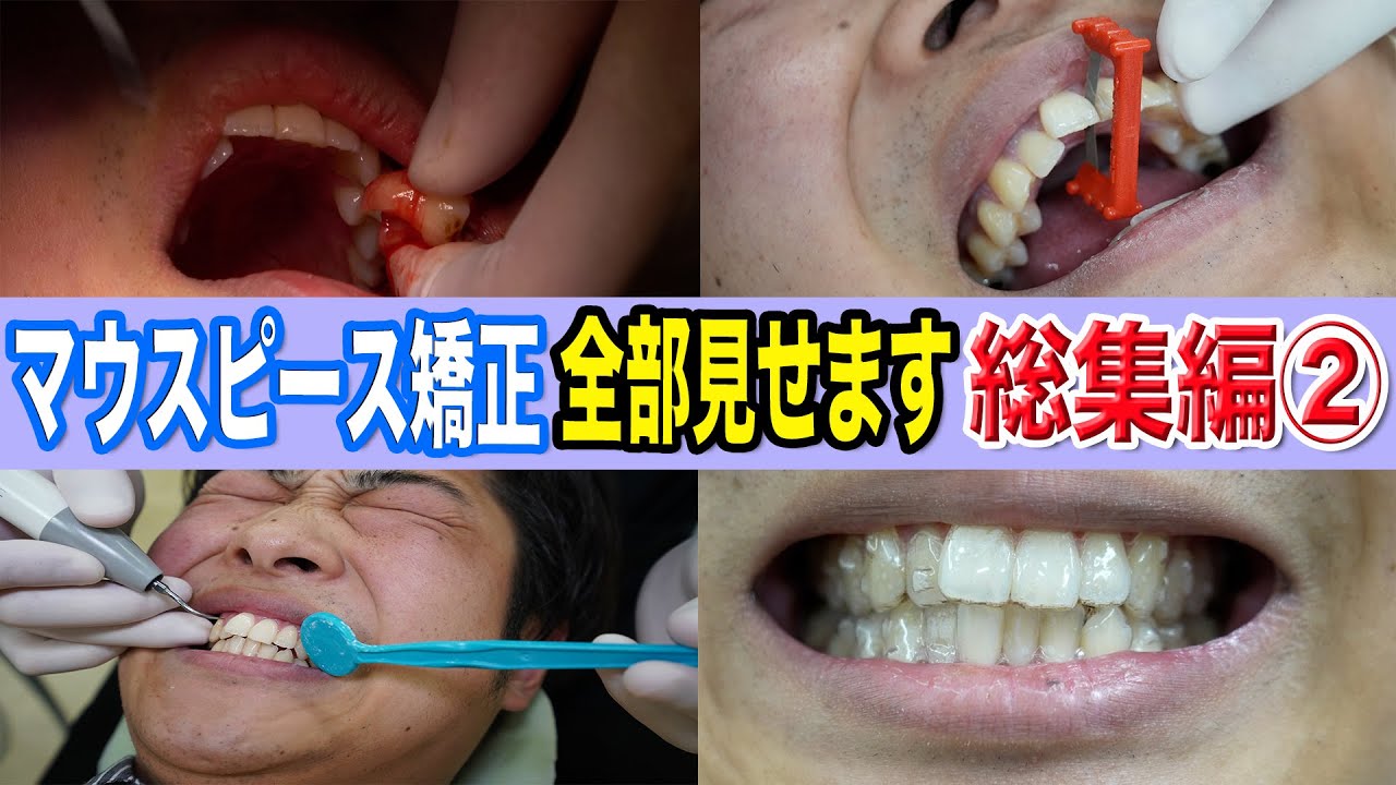 【歯列矯正】必要な処置を全て紹介！スタッフのマウスピース矯正企画総集編②