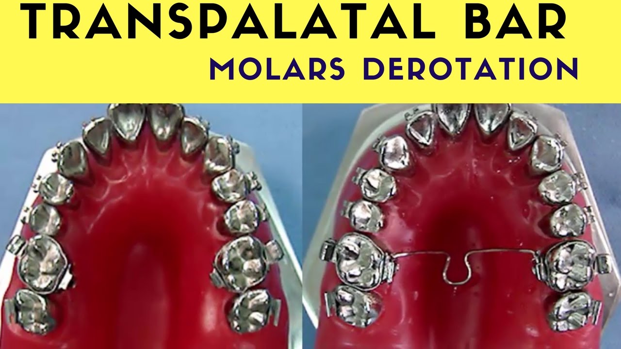 MOLARS DEROTATION