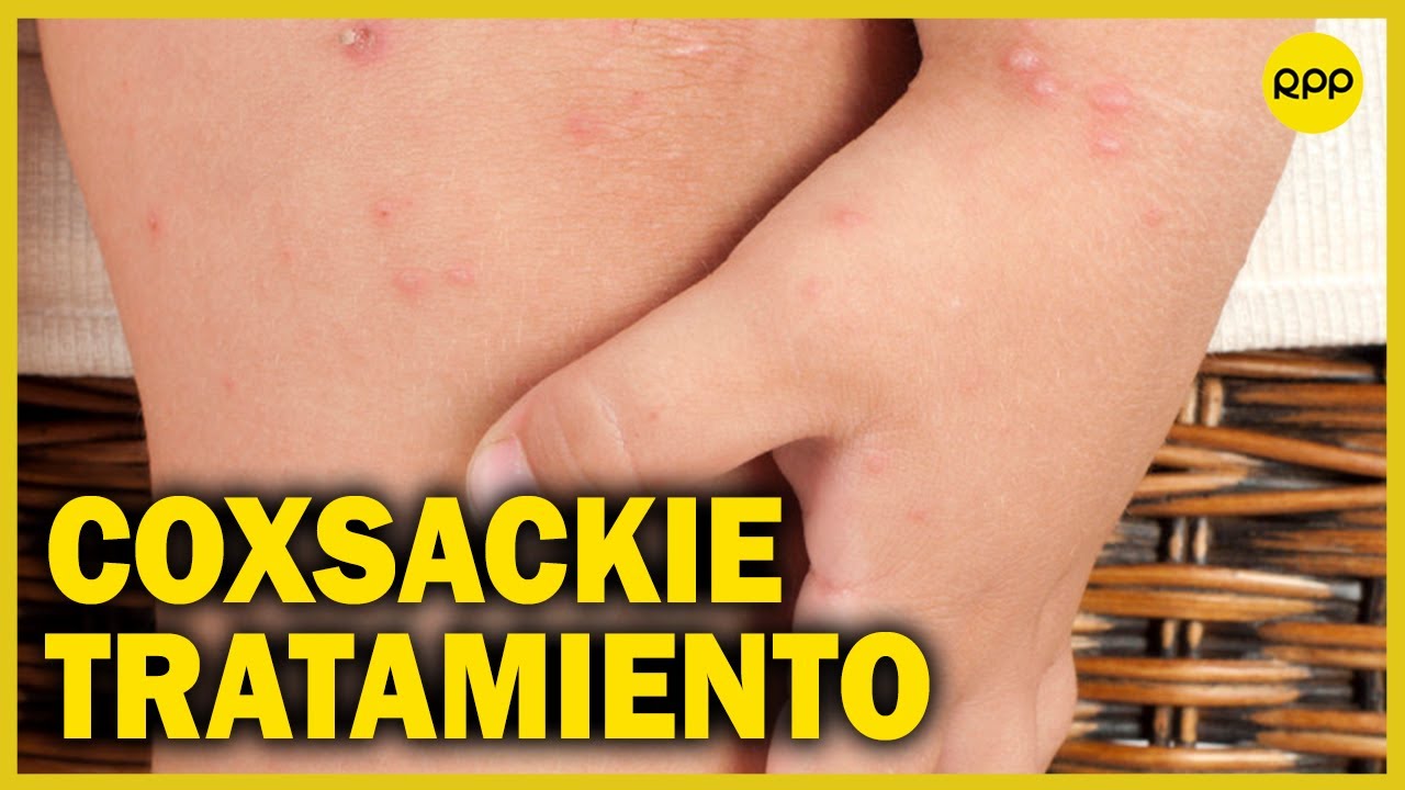 Coxsackie: ¿Cuál es el tratamiento y cómo prevenirlo?