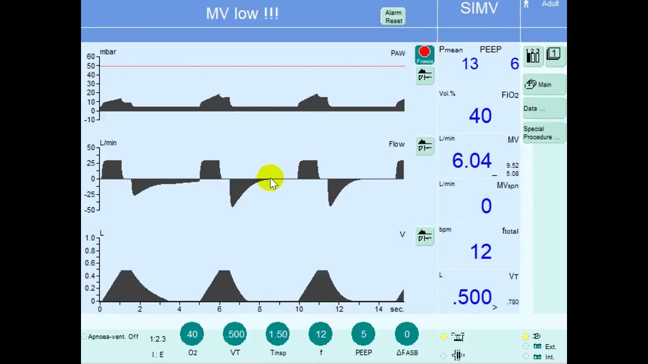 Mastering Volume Controlled Mode of Ventilation (CMV): Detecting Decreased Compliance