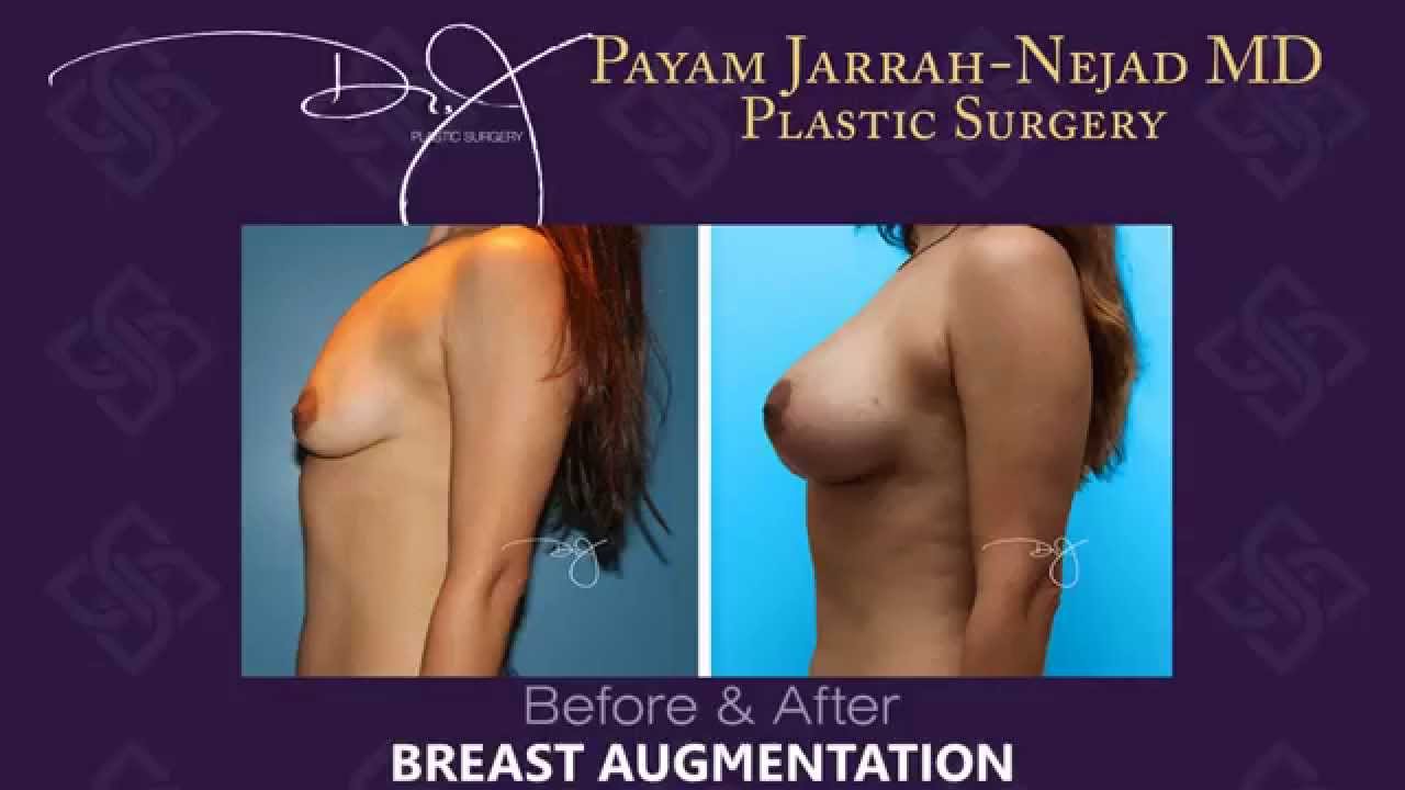 Breast Augmention Before & Afters | Dr. J Plastic Surgery | Payam Jarrah-Nejad