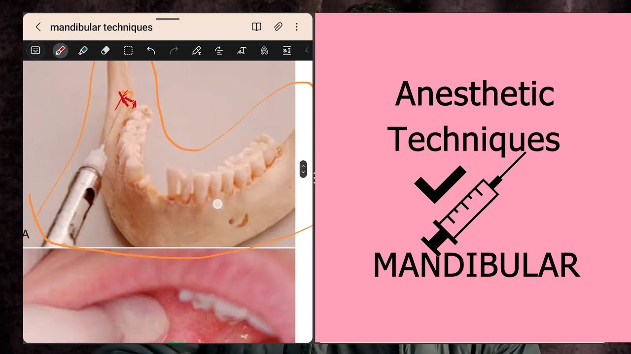 Anesthetic Techniques MANDIBULAR