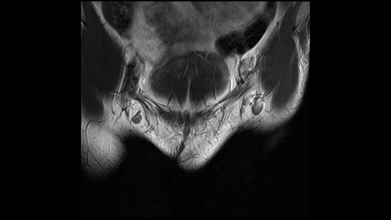 Labial Cyst