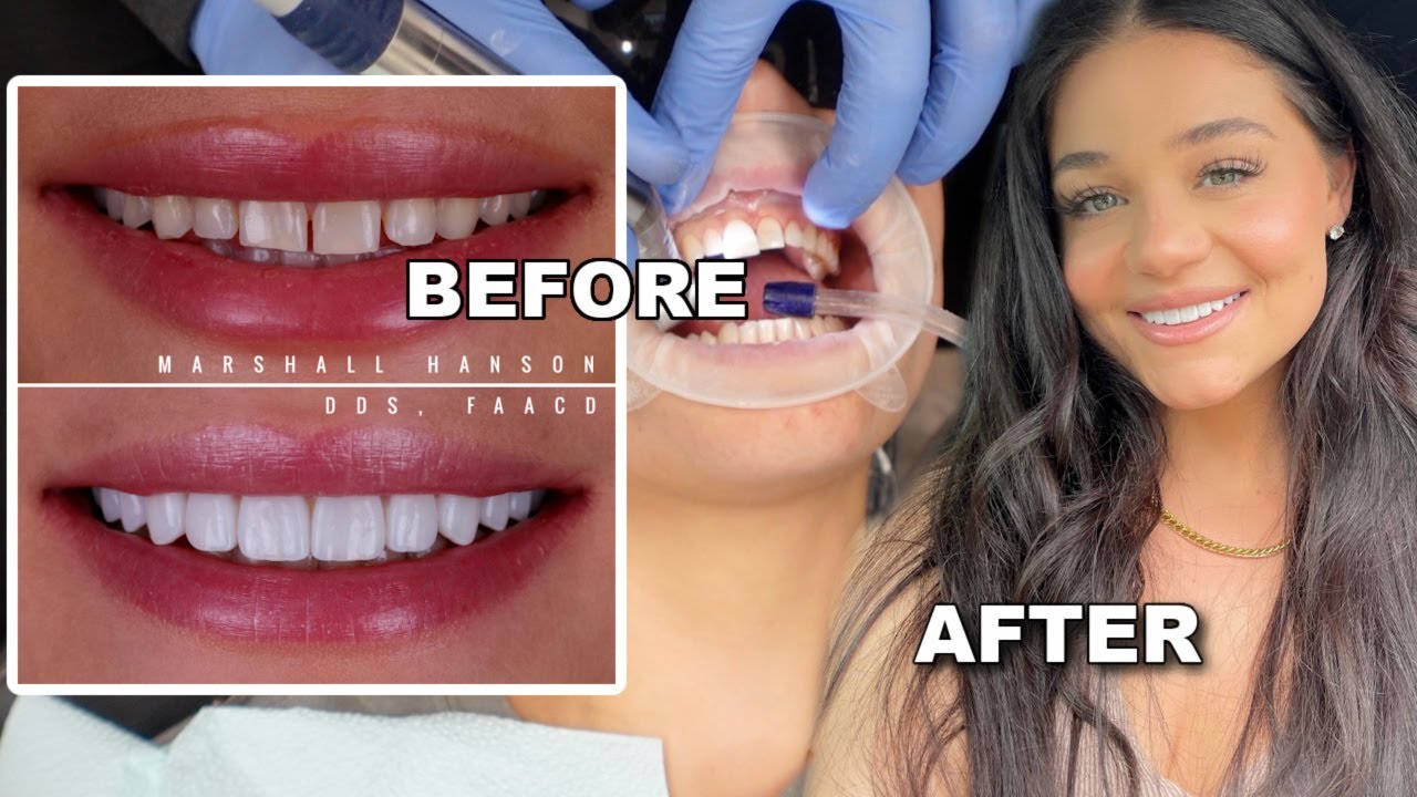 I GOT VENEERS! My Experience 🦷 (Without shaving my natural teeth) | Blissfulbrii