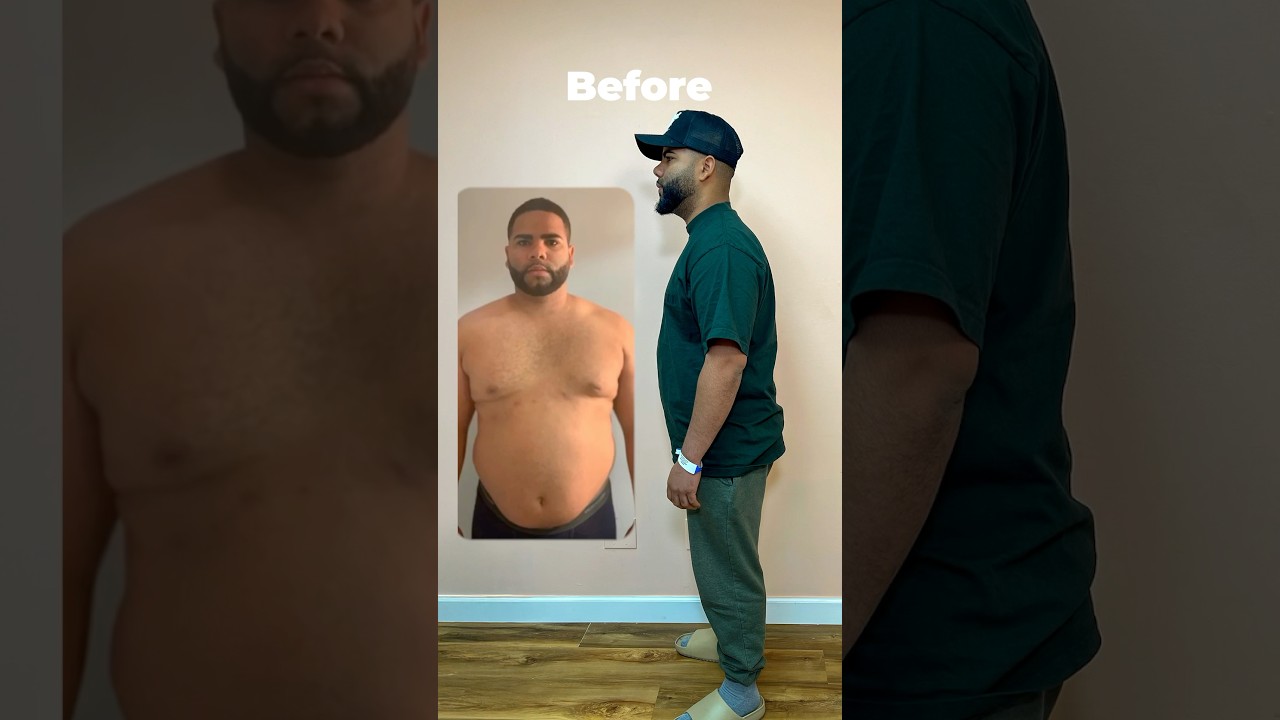 7 Months After Gastric Balloon (-44 lbs)