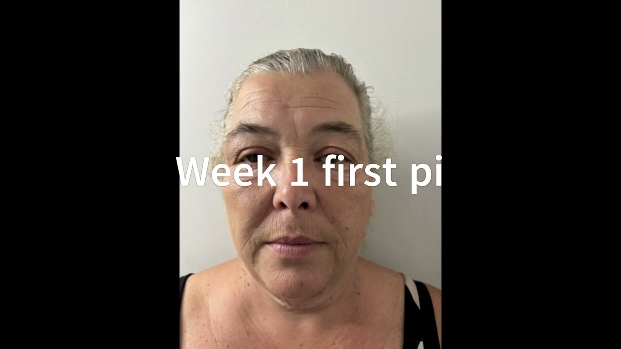 Voula DeBenedictis treating Aging Skin in TSG2025 - Video 6