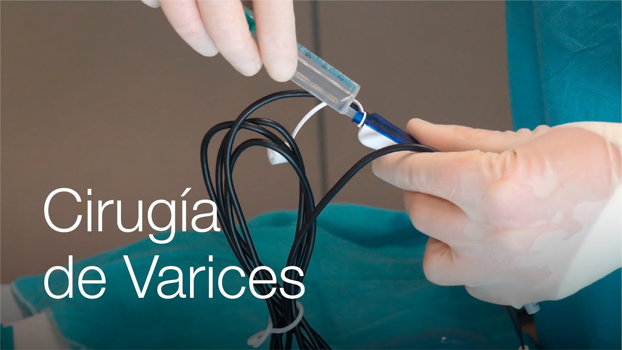 Operación de varices: ¿qué riesgos tiene? ¿Cómo es el postoperatorio?