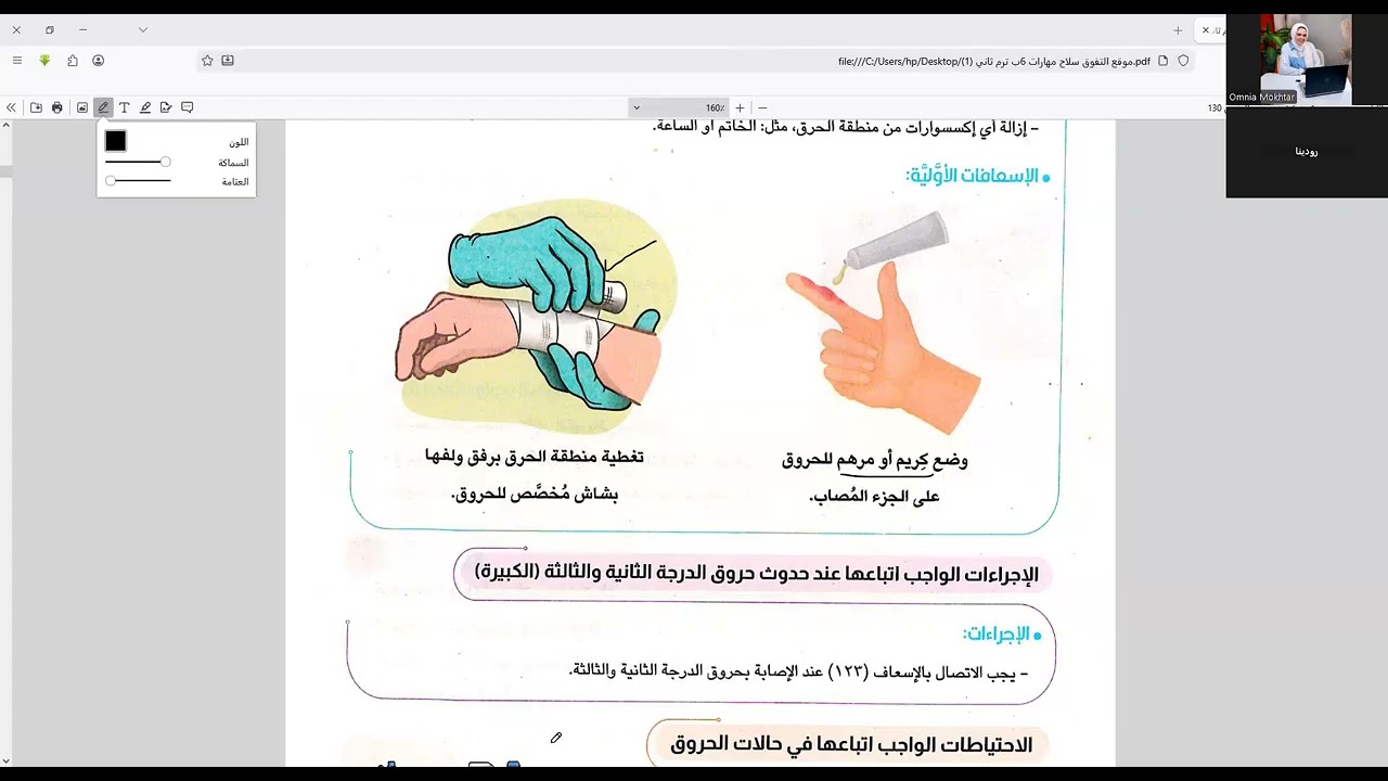 الاسعافات الاوليه للحروق مهارات صف سادس