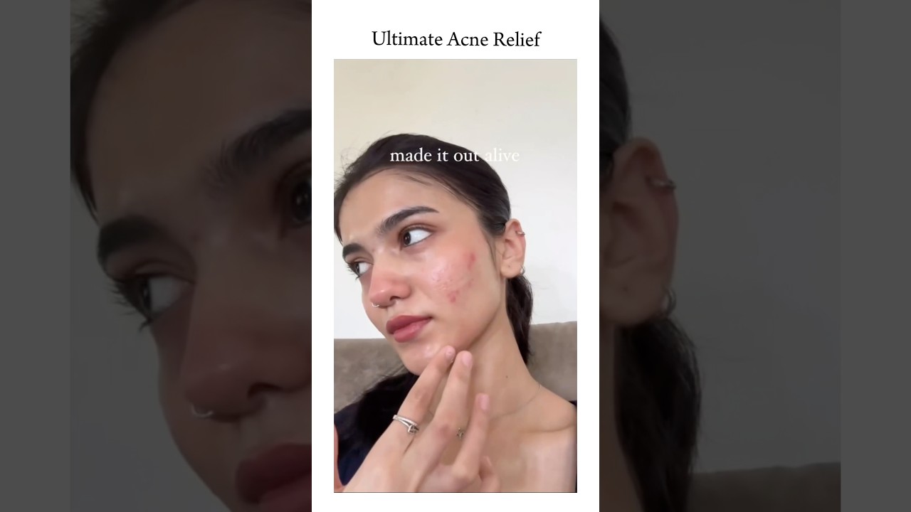 Acne Cure Remedy✨ #acnecare  #ClearSkinTips #PimpleFree #AcneSolution