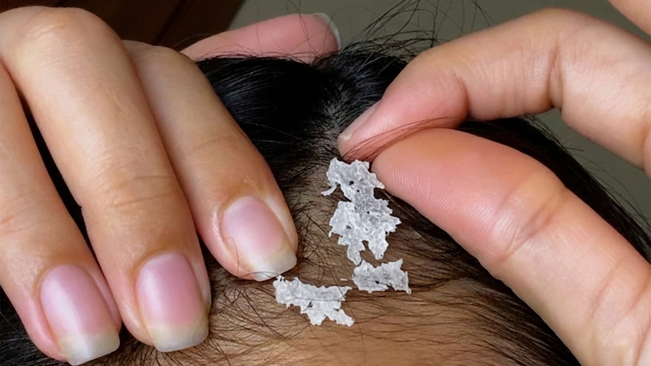 Ultimate Flake Hunt: Long Nails & Tweezers ASMR Scalp #S0024
