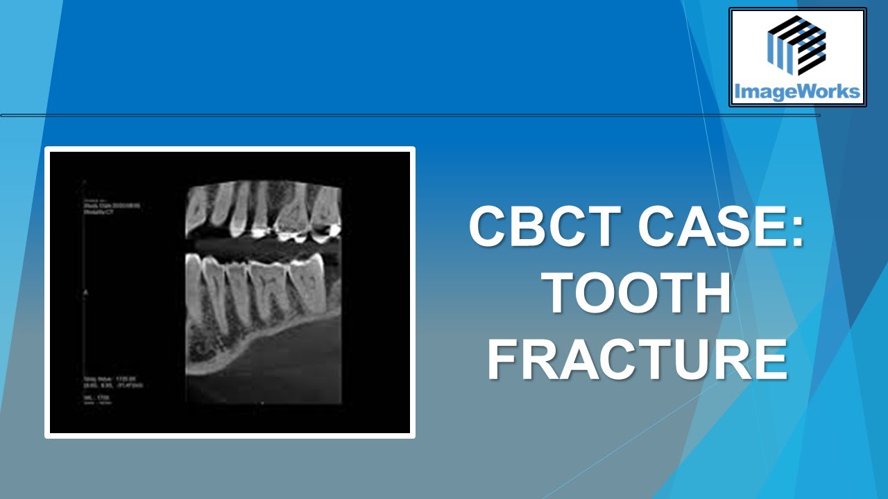 CBCT Case:  Tooth fracture