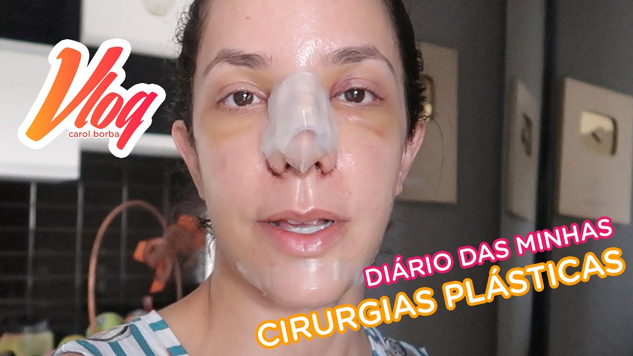 Diário pós cirúrgico da minha RINOPLASTIA + MENTOPLASTIA + PRÓTESE DE SILICONE !!! - Carol Borba