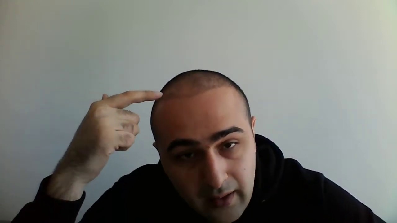 نتائج شهر ونصف بعد عملية زراعة الشعر - مشفي إليت هير