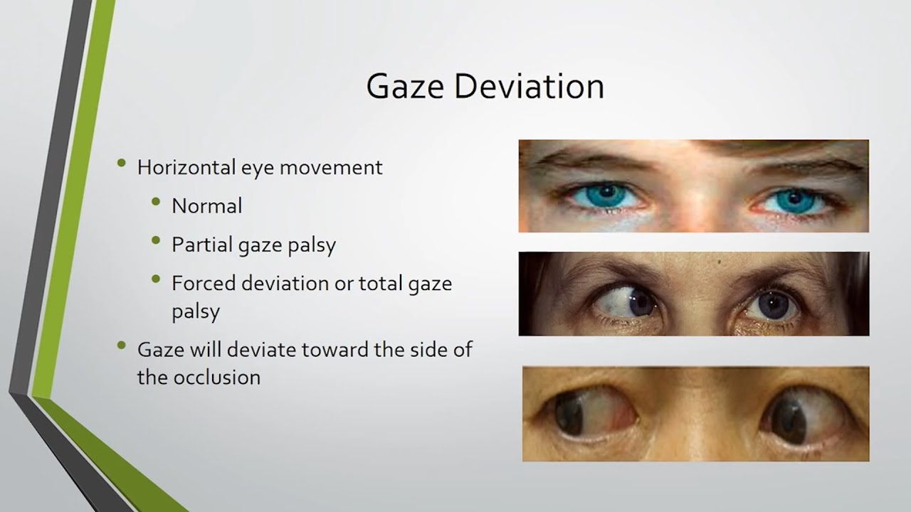 Tuesday Topic 016: The 3 Cortical Signs