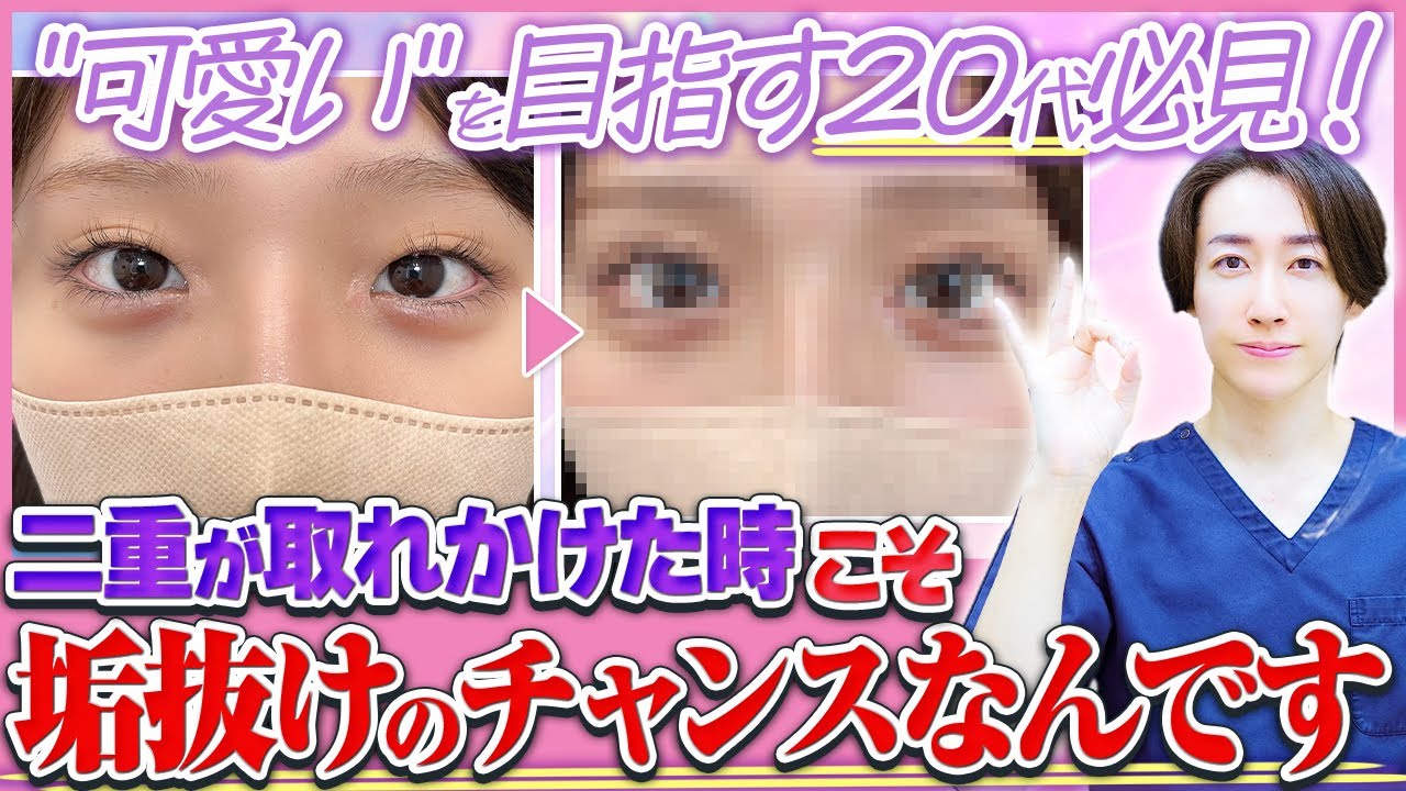 【垢抜け整形】二重埋没法をしても取れやすい人の3つの特徴と二重埋没が取れる前兆とは？二重整形で理想的な二重にする方法を目元のプロが完全解説します【二重埋没 取れる】