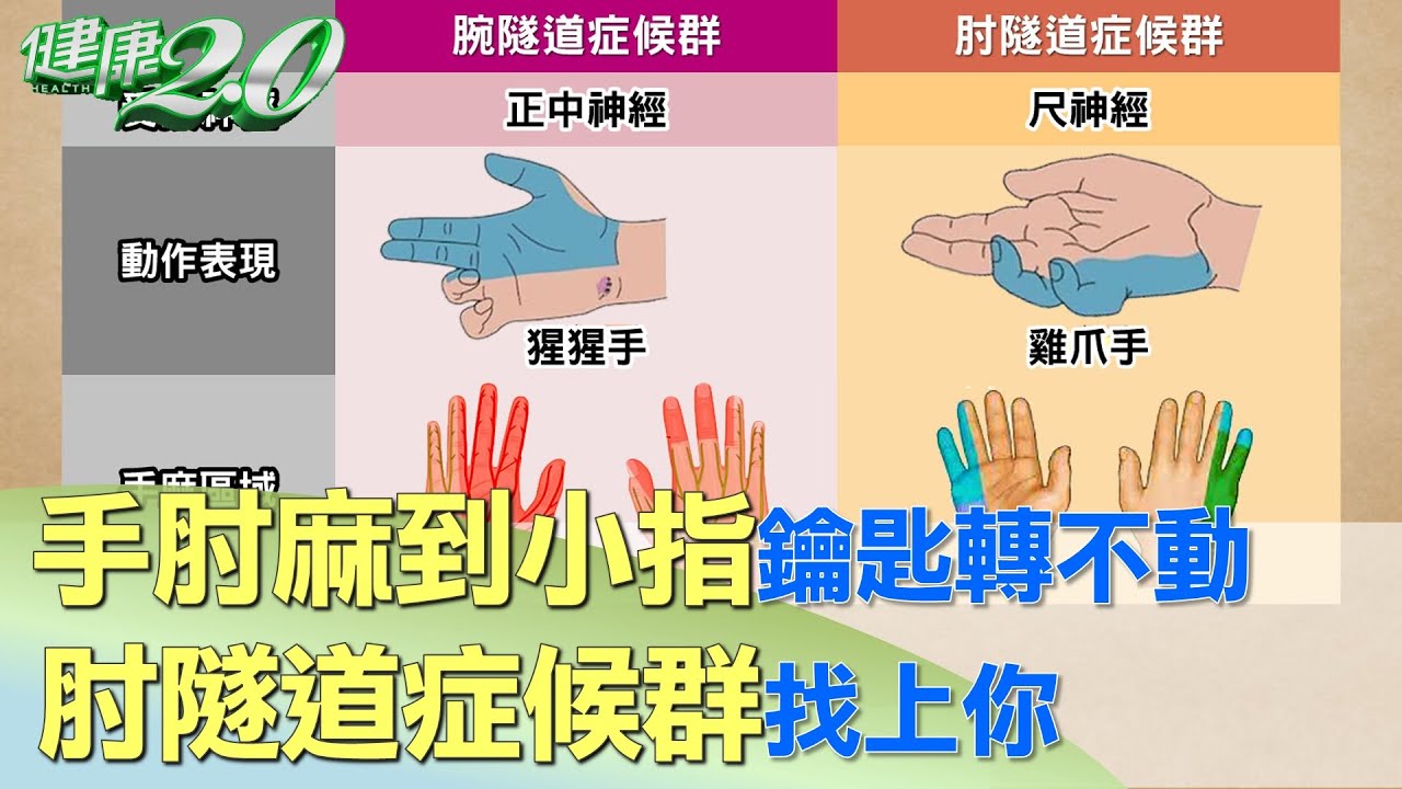 手肘麻到小指連鑰匙都轉不動 肘隧道症候群找上你 健康2.0