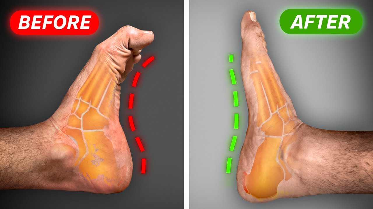 Fix High Arches & Supinated Feet FAST (in 30 Days)