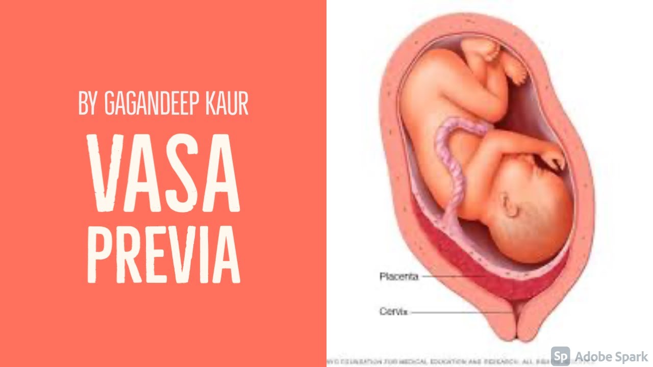 VASA PREVIA (Отдел-8 ОБГ – Аномальные роды)